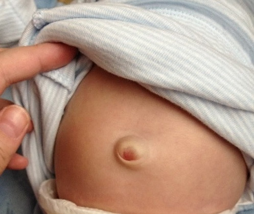 Hầu hết ai lúc bé cũng bị "lồi rốn" như Chaien.