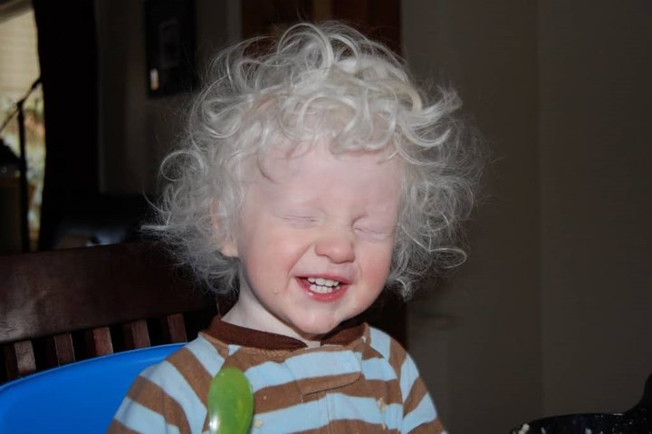 Số trường hợp bạch tạng cao nhất trên thế giới đã được ghi nhận ở Tanzania. Một thực tế là người bạch tạng luôn sống trong nỗi lo sợ bị giết hại để lấy các bộ phận cơ thể làm thuốc theo quan niệm của một số thầy phù thủy.