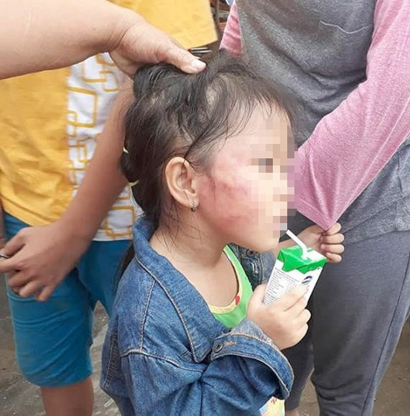 Một bên má của bé D. bị tát bầm tím. (Ảnh do gia đình cung cấp)