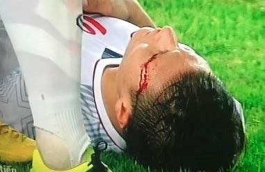 Quang Hải bị rách mí mắt, máu chảy không ngừng.