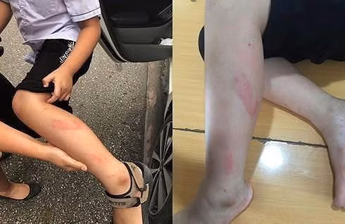 Chân cháu Đ. bầm nhiều vết vì bị cô Trang đánh.