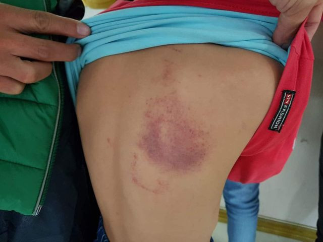 Phạt 5 triệu đồng và đình chỉ công tác giảng dạy 1 tháng đối với cô giáo dùng thước vụt bầm tím vai học sinh.