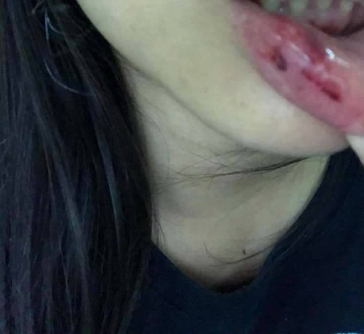 Hình ảnh T.D chia sẻ lên mạng xã hội sau khi tố bị anh rể đánh.