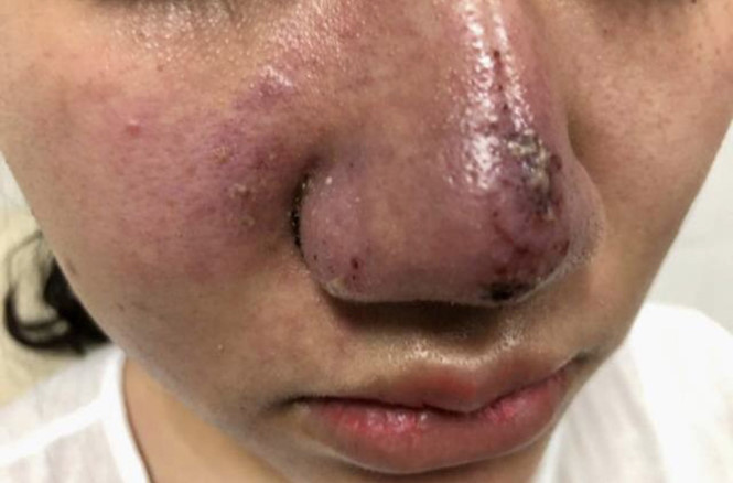 Tiêm filler sai gây tai biến ẢNH: VIỆN DA LIỄU T.Ư CUNG CẤP. Tiêm filler sai gây tai biến ẢNH: VIỆN DA LIỄU T.Ư CUNG CẤP.