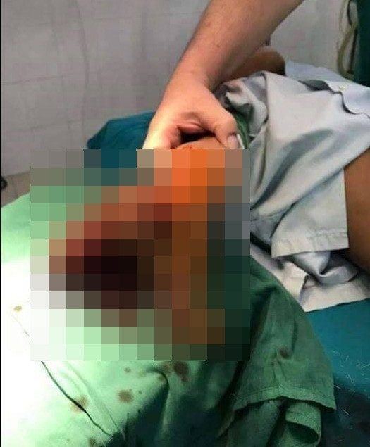 Trước đó, một cậu bé 8 tuổi ở Sơn La đã hủy hoại một bên tay do điện thoại cháy nổ trong lúc vừa chơi game vừa sạc pin.