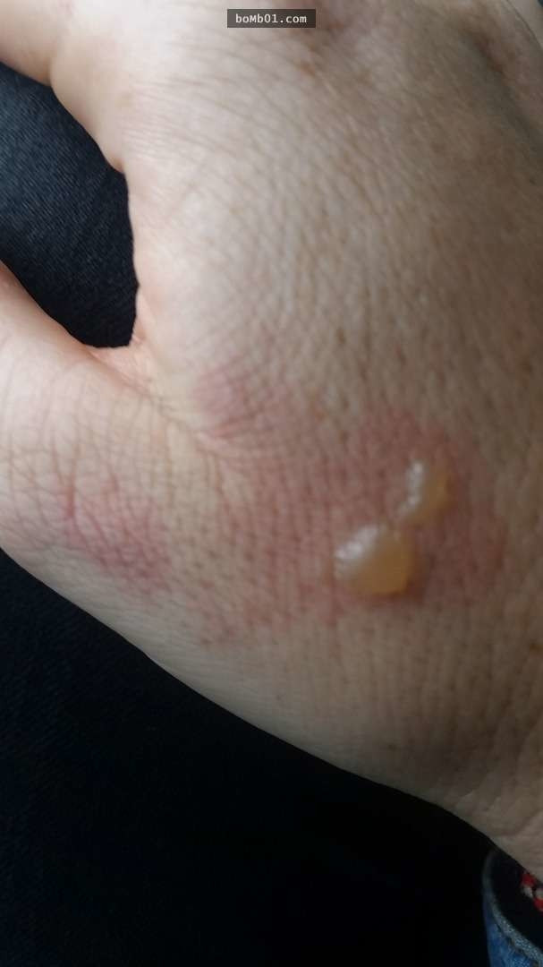 Bàn tay cô cũng bị bỏng nhẹ.