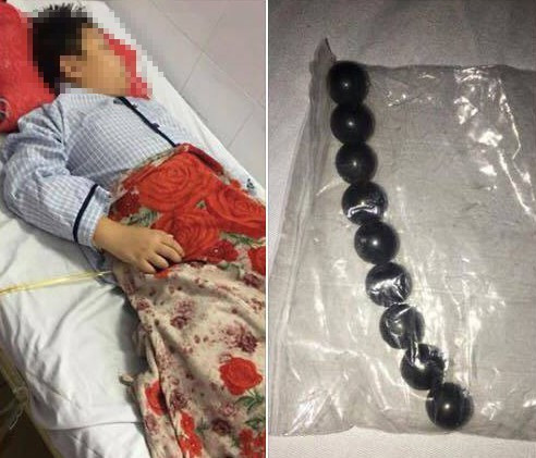 Ảnh trái: Em L. đang được điều trị tại bệnh viện, ảnh phải: 9 viên bi sắt được lấy ra từ ruột của em. Ảnh: CTV