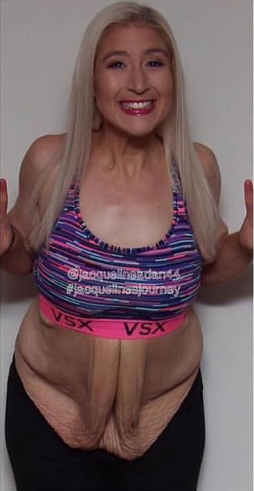 Phần da bụng cũng được cắt bỏ cùng lúc.