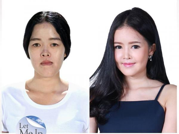 Phẫu thuật thẩm mỹ đã thay đổi số phận một người như thế nào? ảnh 12