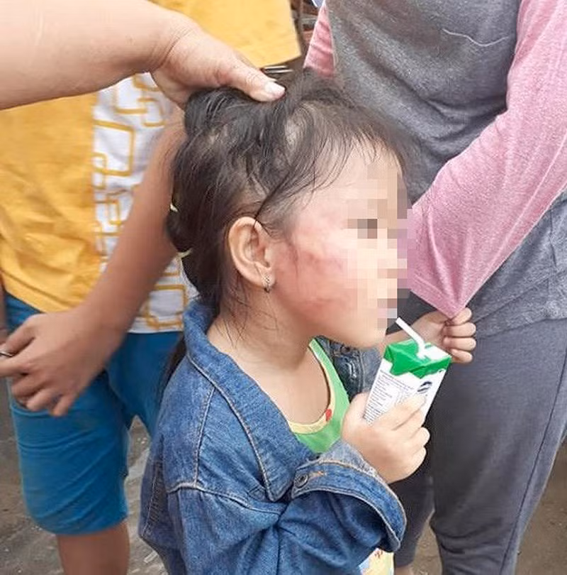 Bé gái 5 tuổi bị bảo mẫu bạo hành (ảnh do gia đình cung cấp).