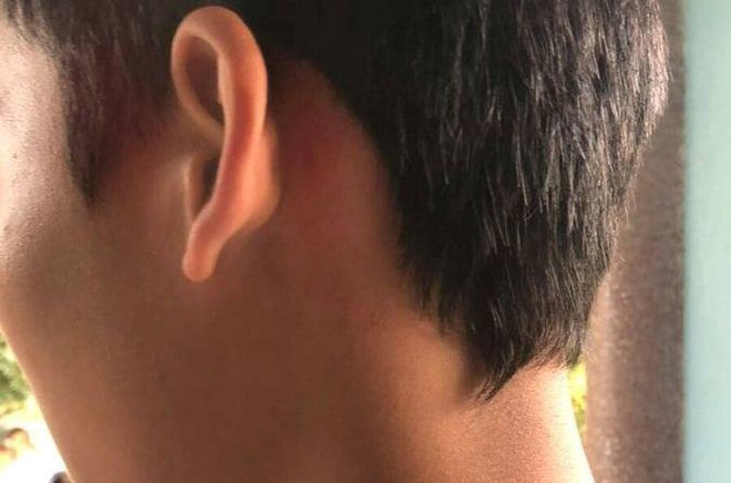 Gia đình cho hay em C. bị đánh vào vùng mang tai, sau gáy và đạp vào bụng. Ảnh: Gia đình cung cấp. Gia đình cho hay em C. bị đánh vào vùng mang tai, sau gáy và đạp vào bụng. Ảnh: Gia đình cung cấp.
