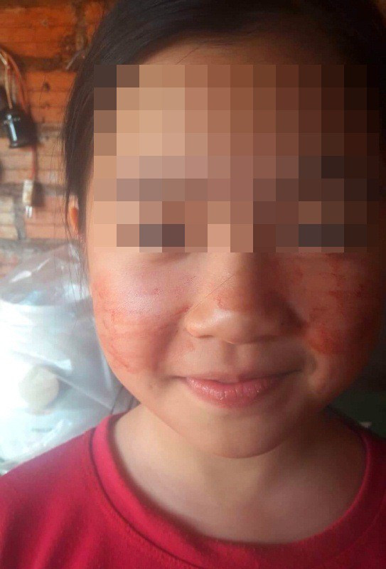 Khi căng thẳng, lo lắng mặt bé N. toát mồ hôi ra máu.