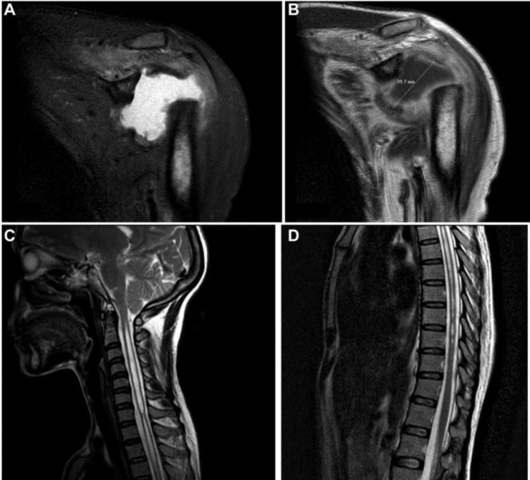 Gorham-Stout là căn bệnh khiến cho một bộ phận xương trong cơ thể bị tiêu biến.