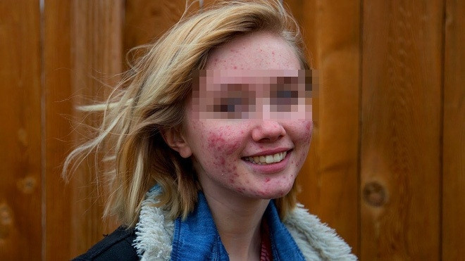 Mụn trứng cá là thứ mà phần lớn teen Mỹ (và hầu hết các nước khác) phải trải qua trong đời.