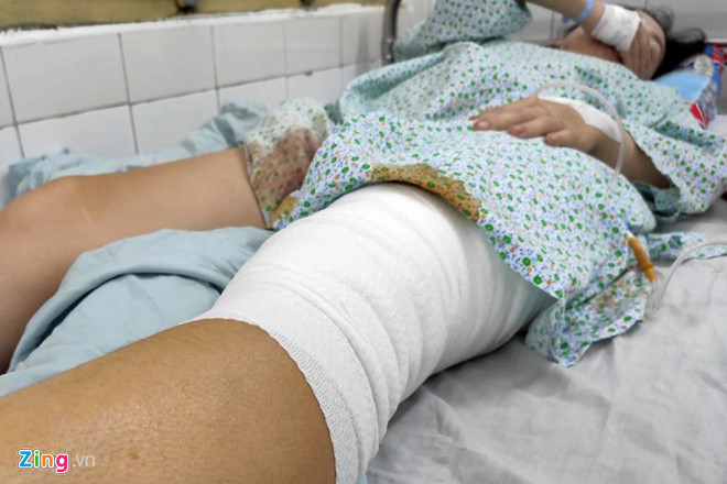 Vết thương của nữ CĐV Hà Nội đã được băng bó để chờ tiếp tục phẫu thuật. Ảnh: Mỹ Hà. Vết thương của nữ CĐV Hà Nội đã được băng bó để chờ tiếp tục phẫu thuật. Ảnh: Mỹ Hà.