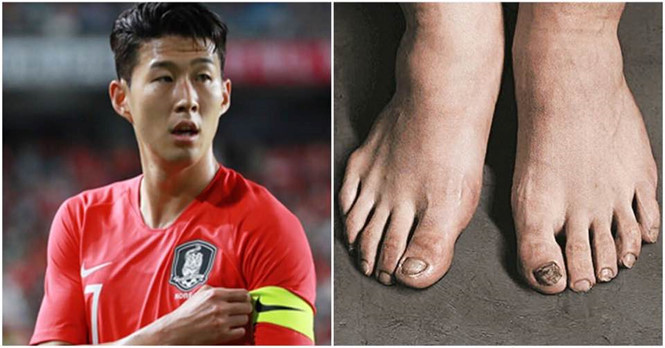 Son Heung-Min “khoe” 2 bàn chân “tan nát”, hệ quả của việc thi đấu liên tục suốt thời gian qua. Ảnh: CHỤP MÀN HÌNH YONHAP NEWS.