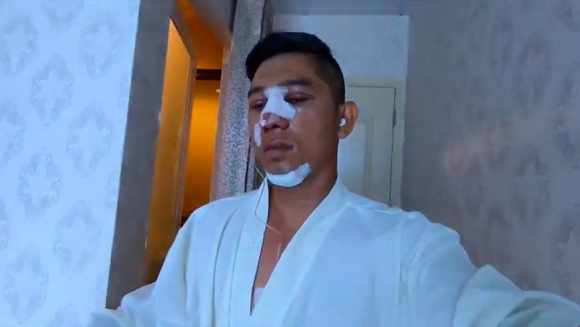 Lương Bằng Quang với gương mặt chưa lành lặn sau ca phẩu thuật.