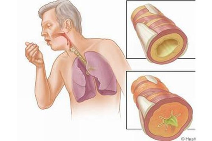 Đu đủ có thể gây ra rối loạn hô hấp: Các papain trong đủ đủ cũng là một chất gây dị ứng tiềm tàng. Ăn đu đủ quá nhiều có thể dẫn đến dị ứng đường hô hấp, hen suyễn, thở khò khè, nghẹt mũi, và trong trường hợp nặng, thậm chí có thể bị khó thở. Đối với phụ nữ mang thai, dị ứng hô hấp cũng có thể ảnh hưởng đến thai nhi, gây ra các biến chứng khác.