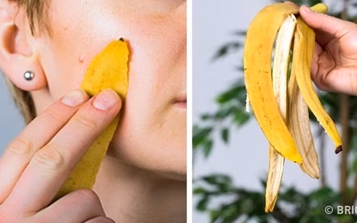 Vỏ chuối giúp giảm ngứa da do muỗi đốt... Chà vỏ chuối lên vùng da bị ngứa từ 10-15 phút.