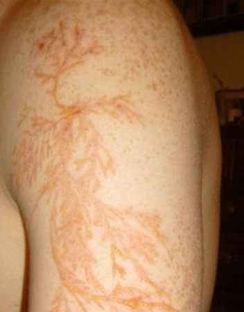 Một “hình xăm hoa sét” trên da người bị sét đánh.