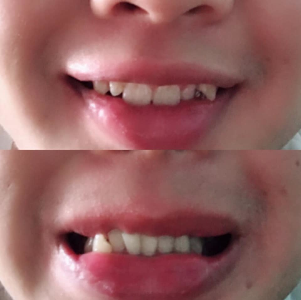 "Ông trời cho tao hàm trên nhưng cũng không cho tao hàm dưới luôn".