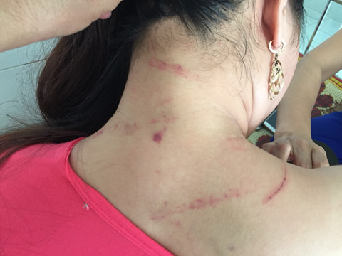 Chị V., vợ Quân bị Quân đánh đập gây nhiều chấn thương.ẢNH: C.T.V.