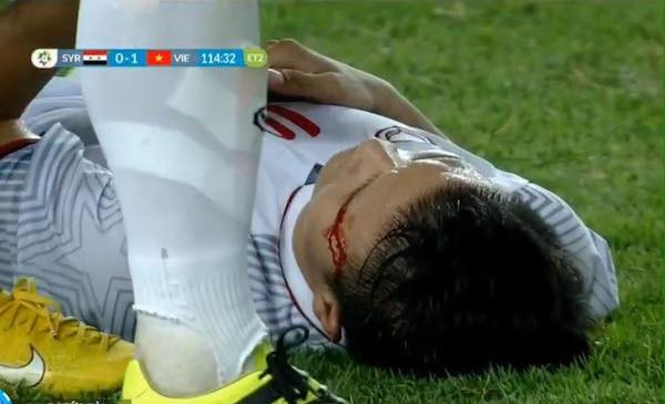Chấn thương của Quang Hải ở trận đấu với Syria.