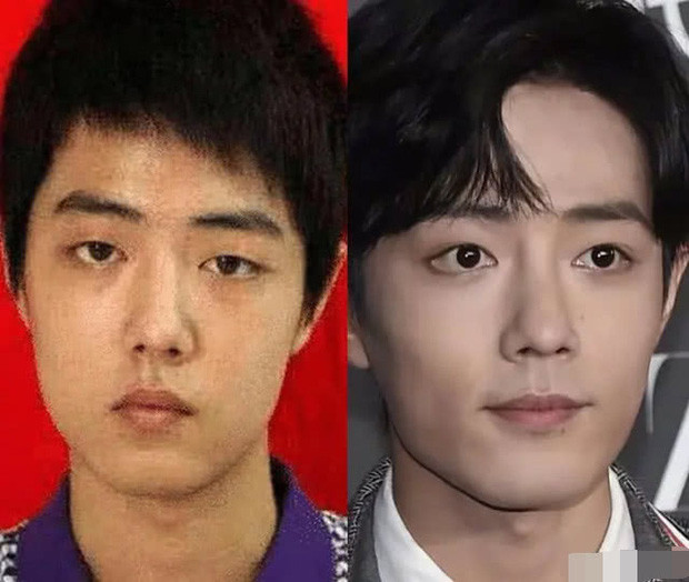 Ảnh quá khứ và hiện tại quá khác biệt khiến Tiêu Chiến bị nghi ngờ phẫu thuật thẩm mỹ