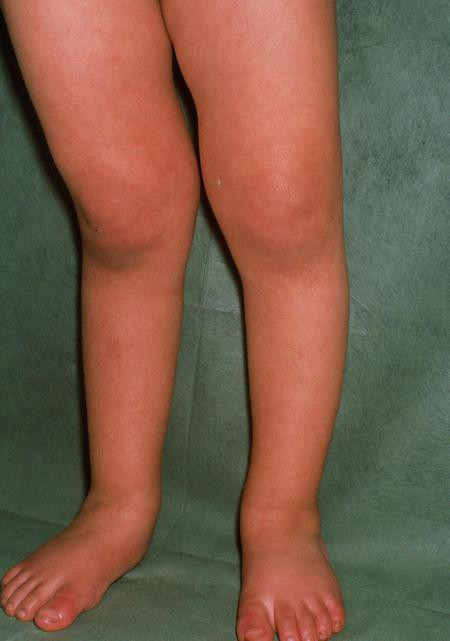 Em bé được chẩn đoán mắc bệnh còi xương.