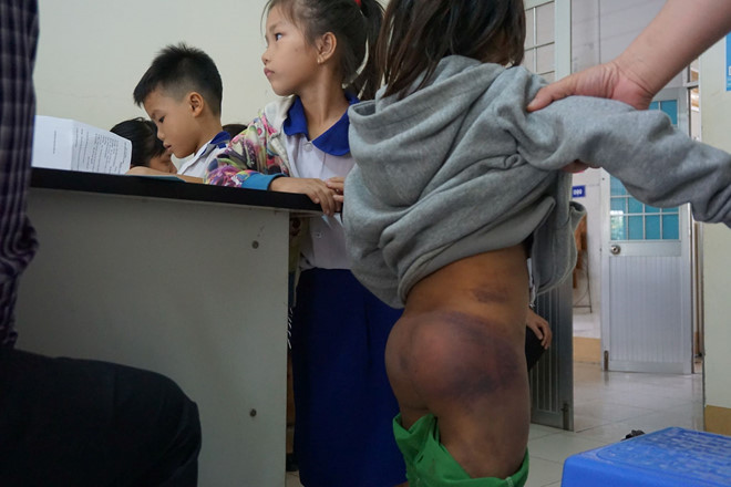 Một cháu bé bị bạo hành với vết bầm tím trên người. Ảnh: GIA BÁCH. Một cháu bé bị bạo hành với vết bầm tím trên người. Ảnh: GIA BÁCH.