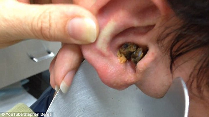 Ráy tai: Thông thường chúng ta luôn làm sạch ráy tai, nhưng thật sự ráy tai này giúp ngăn ngừa vi trùng xâm nhập vào tai. Tuy nhiên, quá nhiều ráy tai cũng có thể gây ngứa, đau tai, mất thính giác, ù tai, mủ chảy ra từ tai...