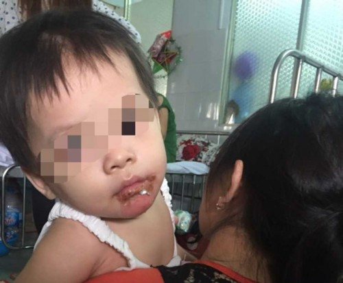 Hiện sức khỏe bé ổn định, vết thương bắt đầu lành sẹo. Ảnh: Tri thức trực tuyến.