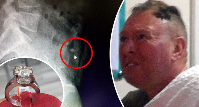 Kết quả chụp X-quang cho thấy chiếc nhẫn kim cương nằm trong dạ dày của vị khách.
