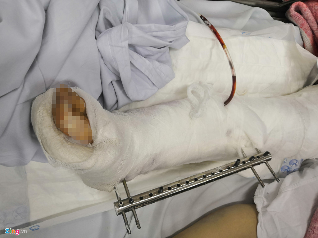Chân phải chị Hảo chấn thương nặng, có nguy cơ phải cắt bỏ. Ảnh: Quang Huy.