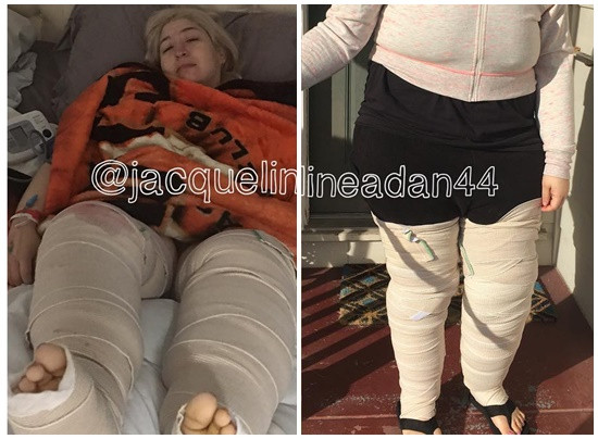 1 năm sau đó, phần da thân dưới và chân cũng được cắt bỏ.