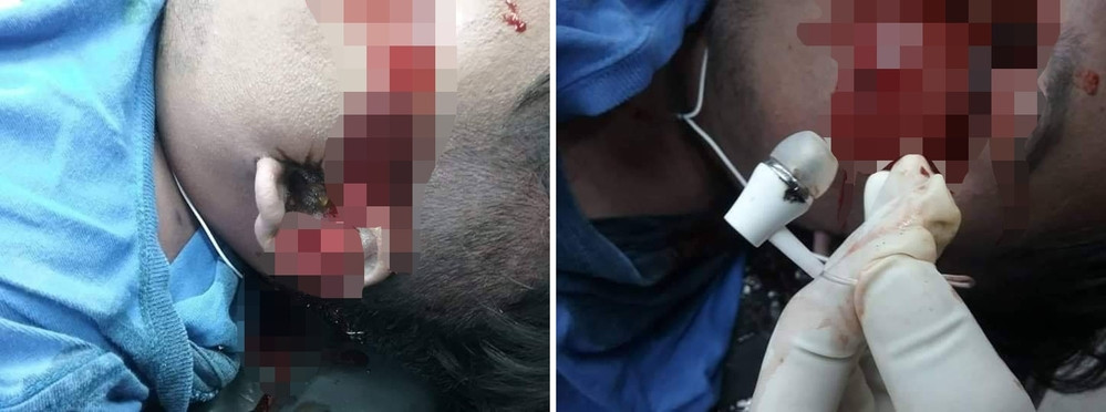 Kiểm tra cho thấy bên tai trái của nam sinh bị bỏng và có máu chảy ra.