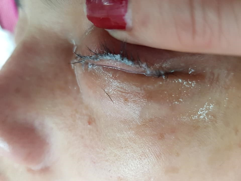 Hình ảnh đôi mắt của cô gái trước khi được loại bỏ keo dán