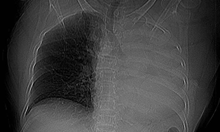 Sặc một viên thuốc, cụ bà xẹp toàn bộ phổi trái
