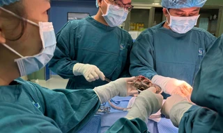 Lấy búi tóc nặng 0,5 kg trong dạ dày một bệnh nhi 6 tuổi