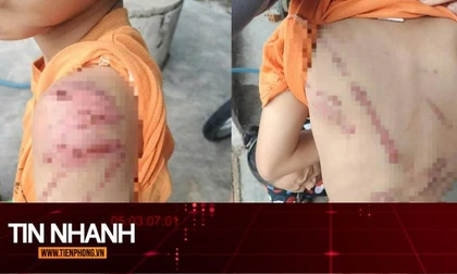 TIN NHANH: Lý do người cha đánh con 10 tuổi bầm tím khắp người