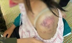 Bé gái 13 tuổi bị bà nội và hai người ông tra khảo, đánh đập dã man vì nghi trộm tiền 