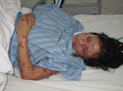 60 nghìn liều vắc xin phòng não mô cầu A, C sắp về Việt Nam