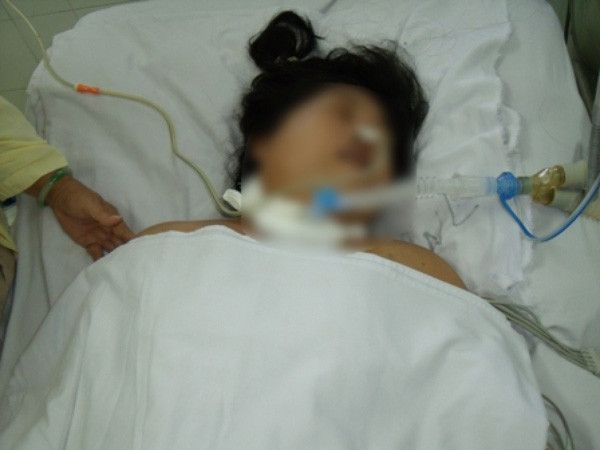 Một trường hợp mắc não mô cầu nguy kịch