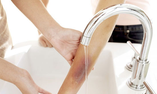 Dùng nước mát (nước tan giá vào mùa đông) ngâm tại vết bỏng sẽ làm giảm nhiệt bề mặt bỏng, giúp vết bỏng không bị tổn thương sâu.