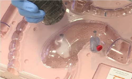 Viên thuốc 'bong bóng' giúp kiểm soát cân nặng