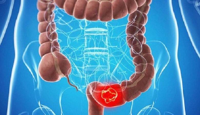 Phát hiện dấu hiệu sớm ung thư đại tràng