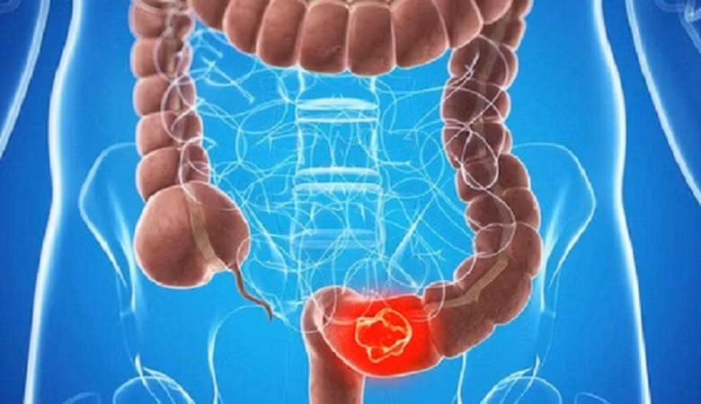 Phát hiện dấu hiệu sớm ung thư đại tràng