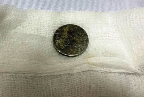 Cục pin tròn dẹt, đường kính 1,6 cm được lấy ra khỏi thực quản bé Tú. Ảnh: Bệnh viện cung cấp