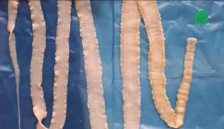 Bị nhiễm sán lợn có chữa khỏi hoàn toàn được không?