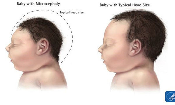 Vi rút Zika gây tật đầu nhỏ ở trẻ em